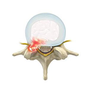 Herniated Disc